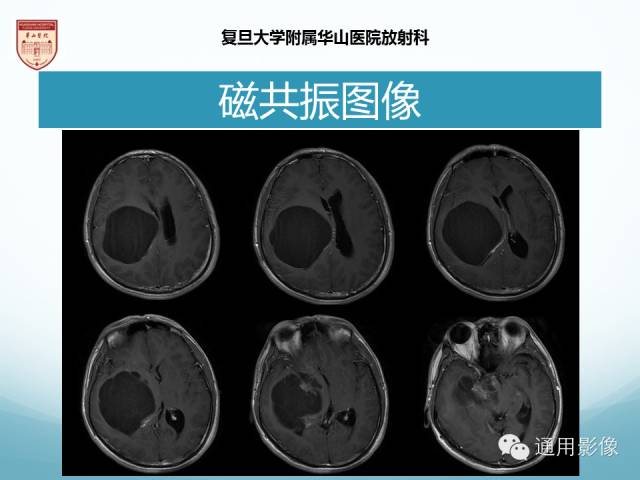 【病例】幕上毛细胞型星形细胞瘤1例MR影像表现