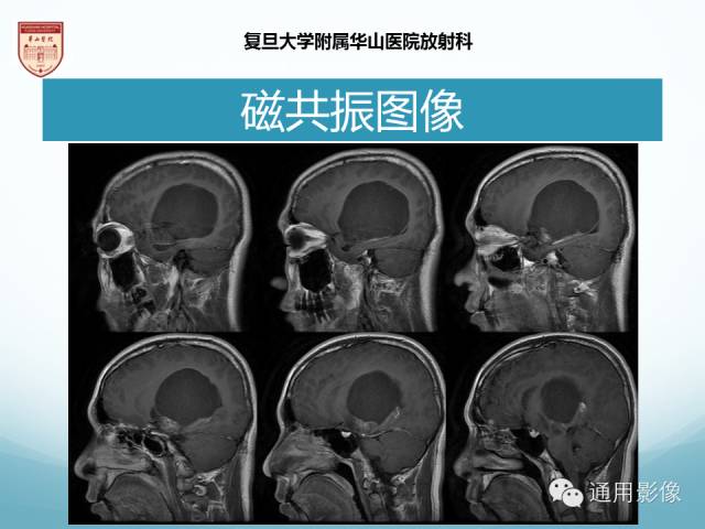 【病例】幕上毛细胞型星形细胞瘤1例MR影像表现