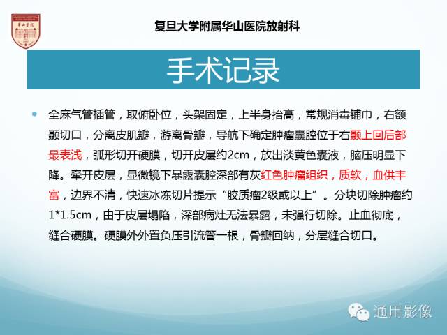 【病例】幕上毛细胞型星形细胞瘤1例MR影像表现