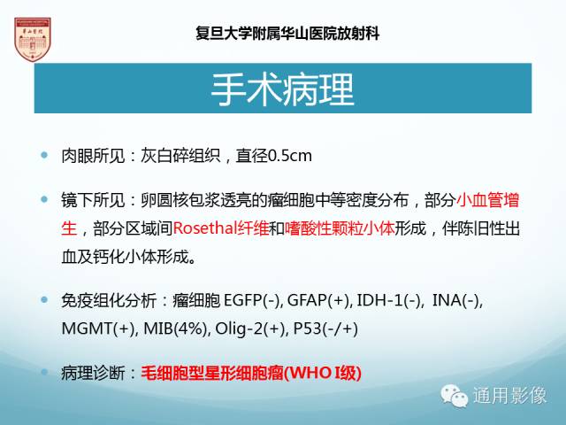 【病例】幕上毛细胞型星形细胞瘤1例MR影像表现