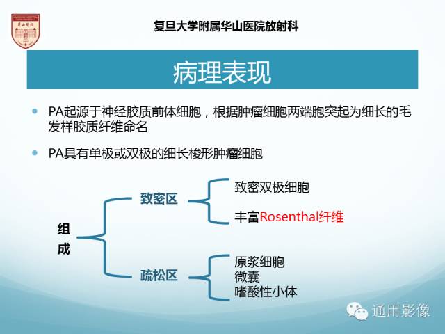 【病例】幕上毛细胞型星形细胞瘤1例MR影像表现