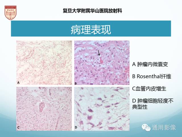 【病例】幕上毛细胞型星形细胞瘤1例MR影像表现