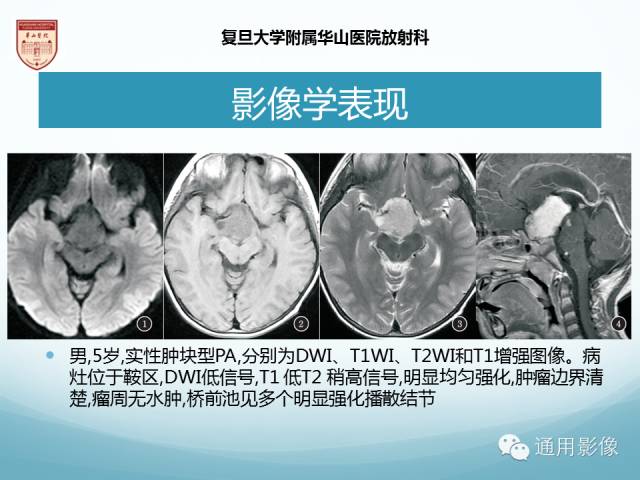 【病例】幕上毛细胞型星形细胞瘤1例MR影像表现
