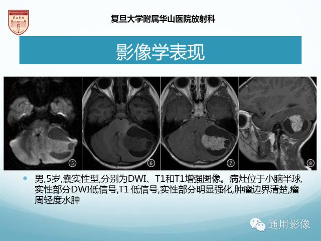 【病例】幕上毛细胞型星形细胞瘤1例MR影像表现