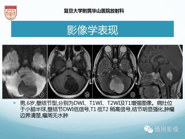 【病例】幕上毛细胞型星形细胞瘤1例MR影像表现
