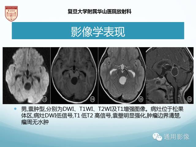 【病例】幕上毛细胞型星形细胞瘤1例MR影像表现