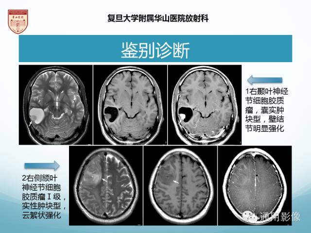 【病例】幕上毛细胞型星形细胞瘤1例MR影像表现