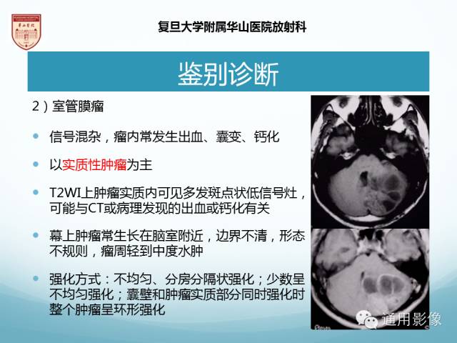 【病例】幕上毛细胞型星形细胞瘤1例MR影像表现