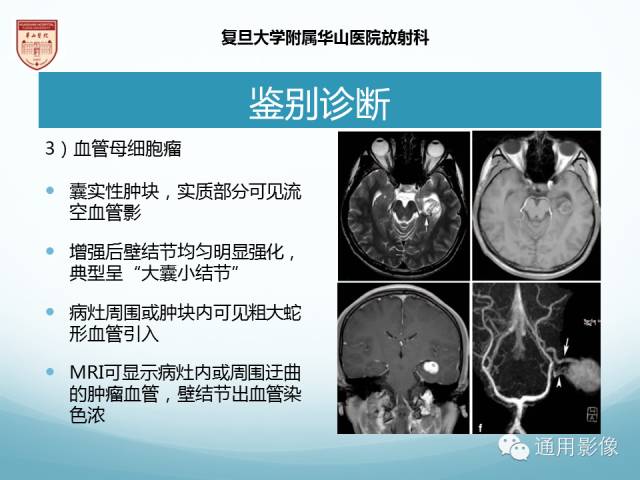 【病例】幕上毛细胞型星形细胞瘤1例MR影像表现