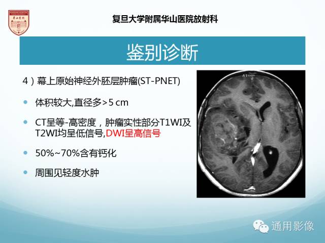 【病例】幕上毛细胞型星形细胞瘤1例MR影像表现