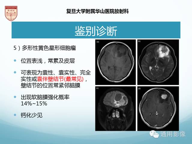 【病例】幕上毛细胞型星形细胞瘤1例MR影像表现