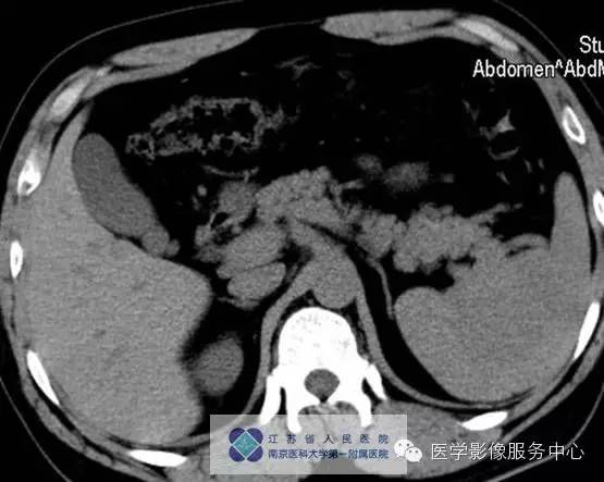【病例】脾血管瘤1例CT影像表现