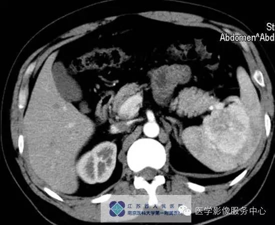 【病例】脾血管瘤1例CT影像表现 【病例】脾血管瘤1例CT影像表现