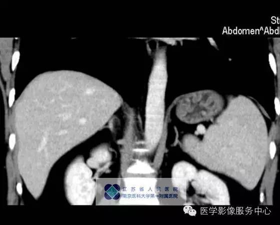 【病例】脾血管瘤1例CT影像表现 【病例】脾血管瘤1例CT影像表现