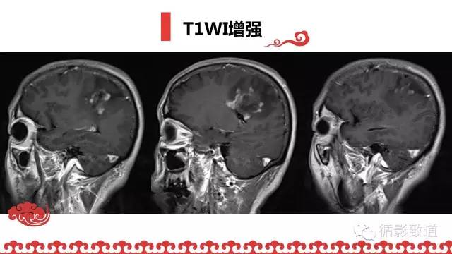 【病例】肿瘤样脱髓鞘1例MR影像表现