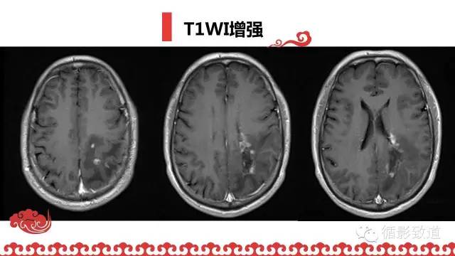 【病例】肿瘤样脱髓鞘1例MR影像表现