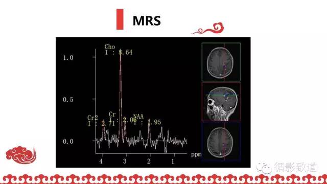 【病例】肿瘤样脱髓鞘1例MR影像表现