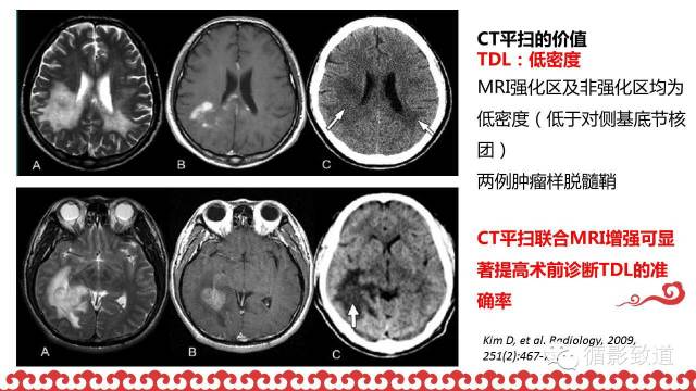 【病例】肿瘤样脱髓鞘1例MR影像表现