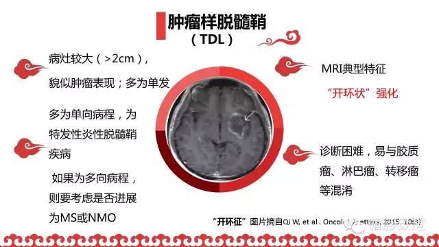 【病例】肿瘤样脱髓鞘1例MR影像表现