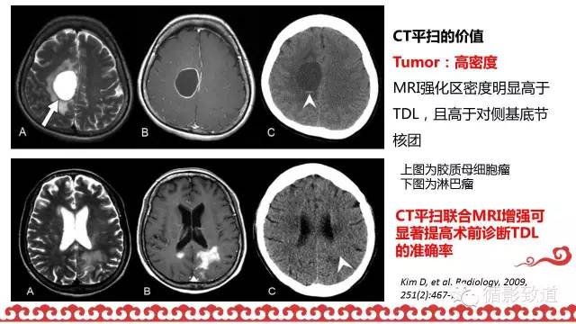 【病例】肿瘤样脱髓鞘1例MR影像表现