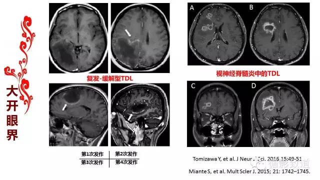 【病例】肿瘤样脱髓鞘1例MR影像表现