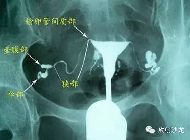 子宫输卵管造影的结果判断