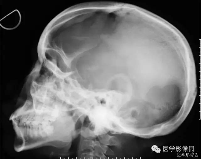 【病例】颅骨黄色瘤病1例 【病例】颅骨黄色瘤病1例