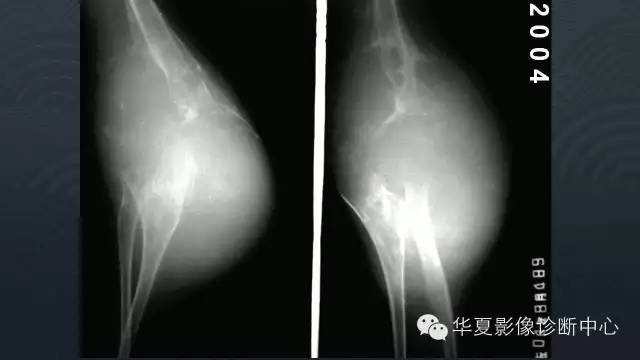 【病例】血友病性关节炎伴假囊肿形成1例X线影像表现