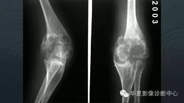 【病例】血友病性关节炎伴假囊肿形成1例X线影像表现