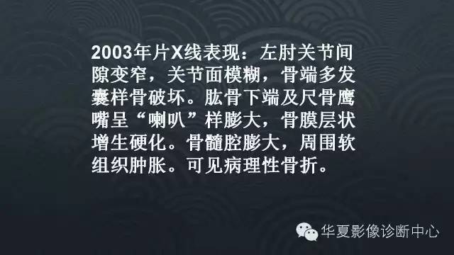 【病例】血友病性关节炎伴假囊肿形成1例X线影像表现