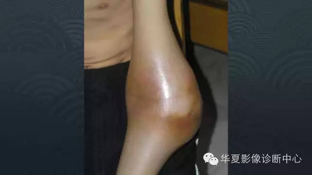 【病例】血友病性关节炎伴假囊肿形成1例X线影像表现