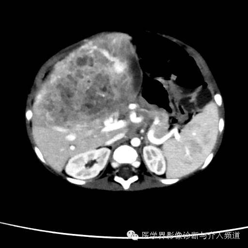 【病例】肝母细胞瘤1例CT影像表现 【病例】肝母细胞瘤1例CT影像表现
