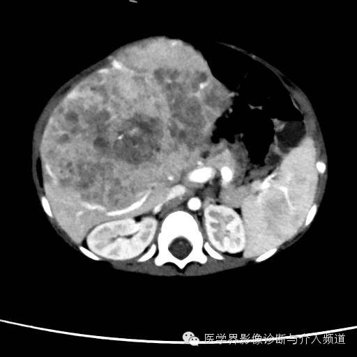 【病例】肝母细胞瘤1例CT影像表现 【病例】肝母细胞瘤1例CT影像表现