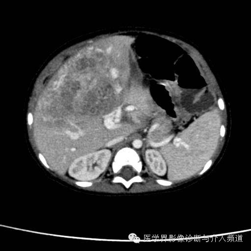 【病例】肝母细胞瘤1例CT影像表现 【病例】肝母细胞瘤1例CT影像表现