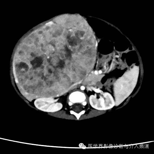 【病例】肝母细胞瘤1例CT影像表现 【病例】肝母细胞瘤1例CT影像表现