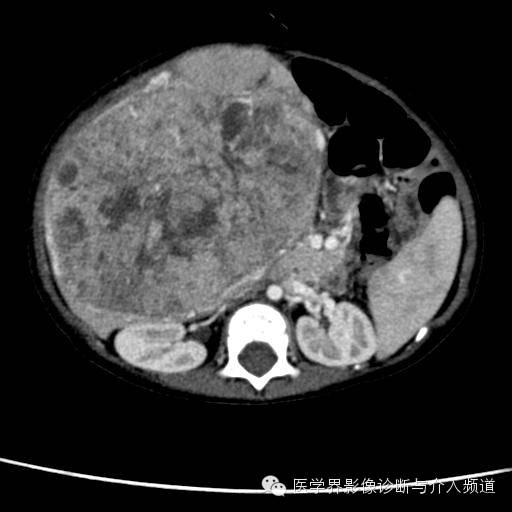 【病例】肝母细胞瘤1例CT影像表现 【病例】肝母细胞瘤1例CT影像表现