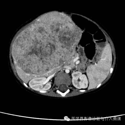 【病例】肝母细胞瘤1例CT影像表现 【病例】肝母细胞瘤1例CT影像表现