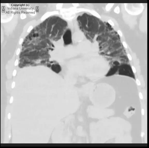 【病例】普通型间质性肺炎/特发性肺间质纤维化1例CT 【病例】普通型间质性肺炎/特发性肺间质纤维化1例CT