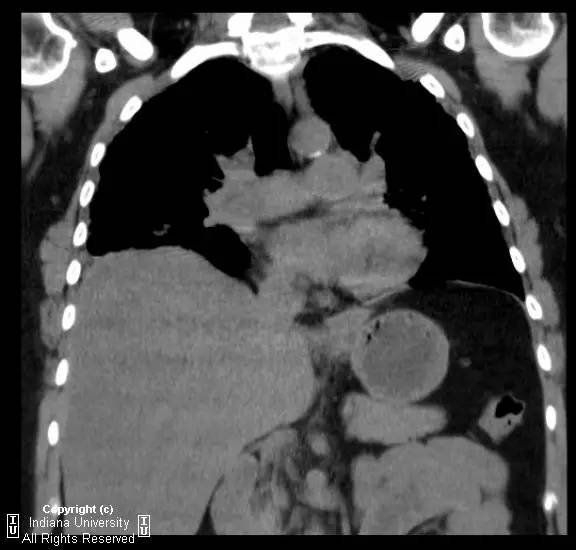 【病例】普通型间质性肺炎/特发性肺间质纤维化1例CT 【病例】普通型间质性肺炎/特发性肺间质纤维化1例CT