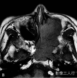 鼻腔及鼻窦腺样囊性癌的诊断要点及鉴别诊断 鼻腔及鼻窦腺样囊性癌的诊断要点及鉴别诊断
