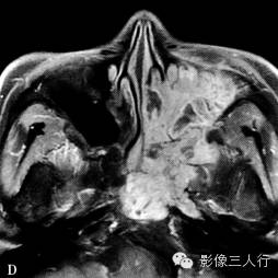 鼻腔及鼻窦腺样囊性癌的诊断要点及鉴别诊断 鼻腔及鼻窦腺样囊性癌的诊断要点及鉴别诊断