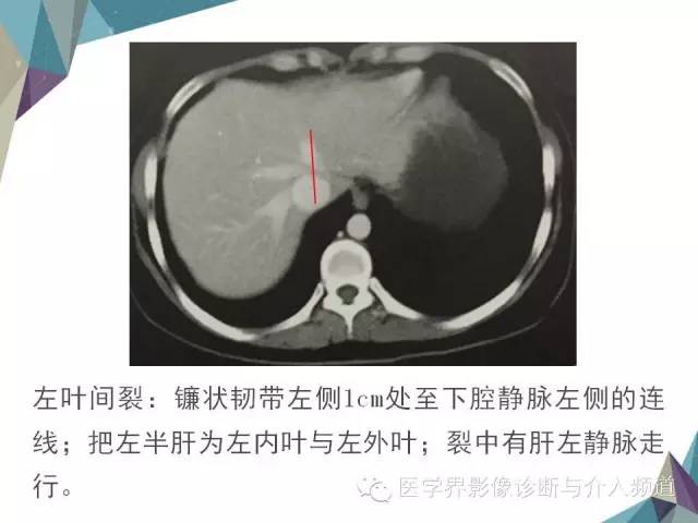 【PPT】肝脏影像学分段