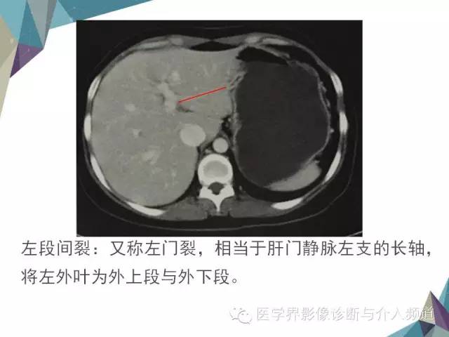 【PPT】肝脏影像学分段