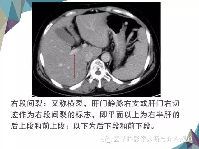 【PPT】肝脏影像学分段