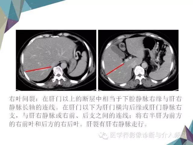 【PPT】肝脏影像学分段