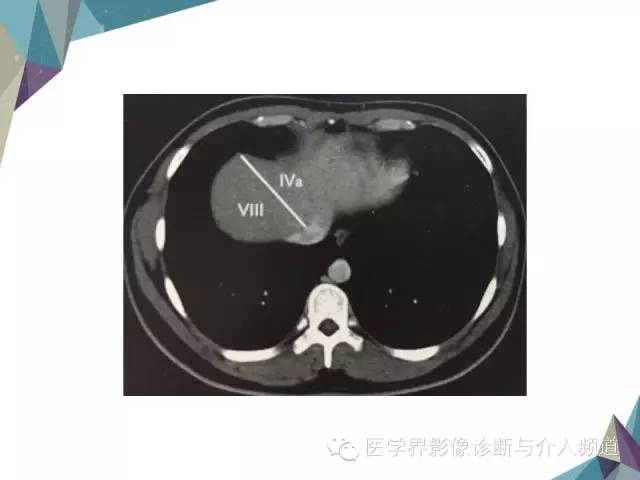 【PPT】肝脏影像学分段