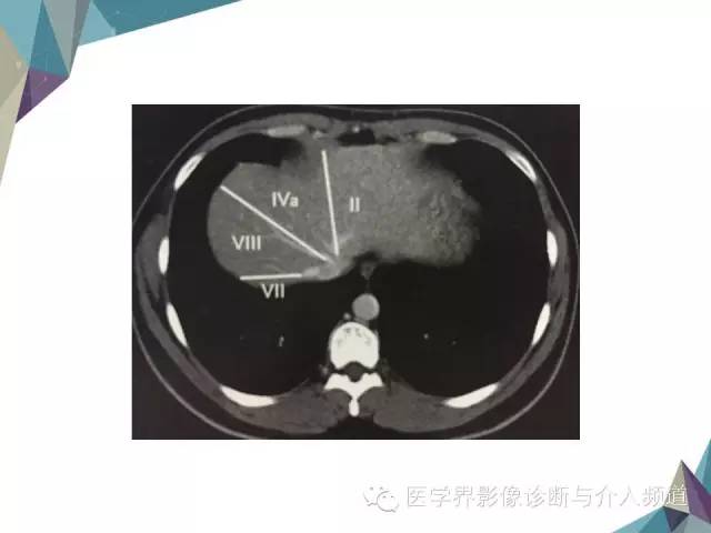 【PPT】肝脏影像学分段