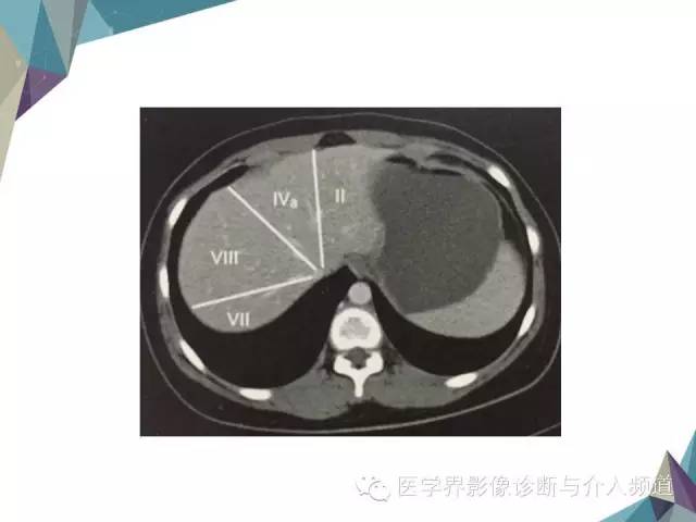 【PPT】肝脏影像学分段
