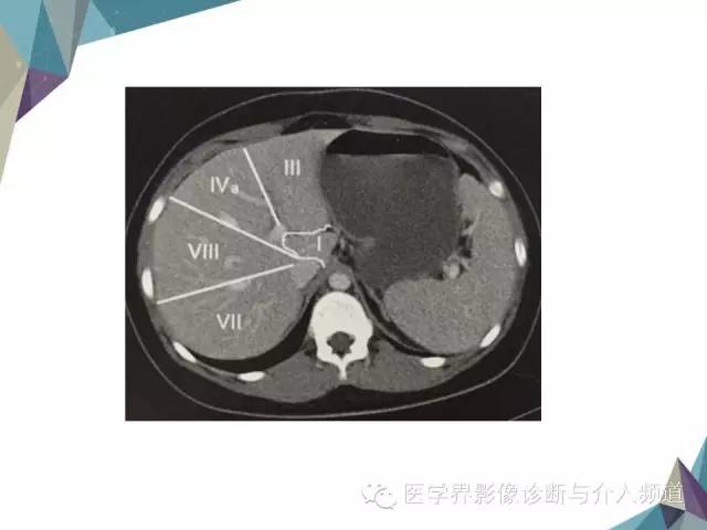 【PPT】肝脏影像学分段
