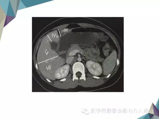 【PPT】肝脏影像学分段